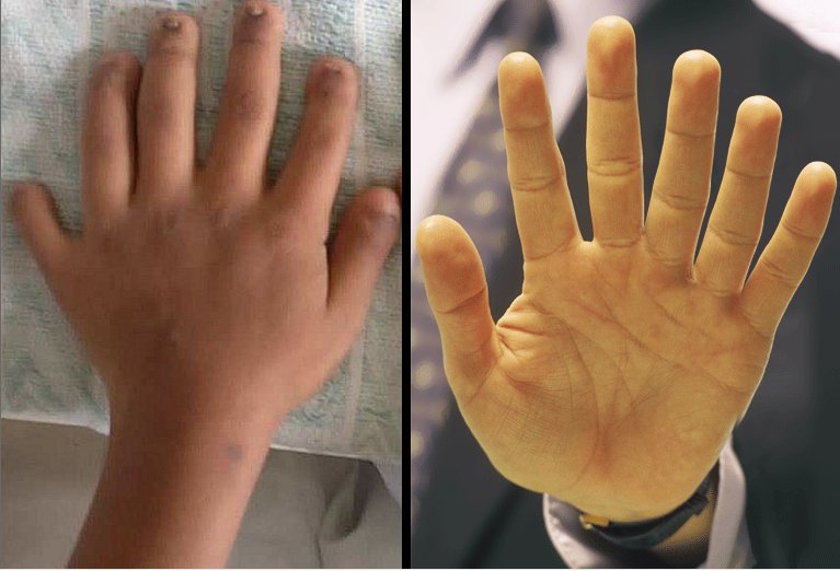 Polidactilia: Humanos com mãos com seis dedos podem ampliar suas habilidades