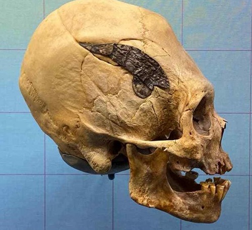 Crânio alongado com emenda de metal data de 2.000 anos atrás